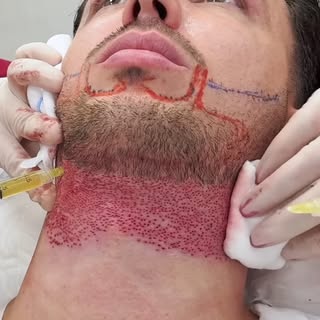 Perché, per il trapianto di Ettore, non abbiamo usato anche i capelli per un risultato più pieno?
Le
