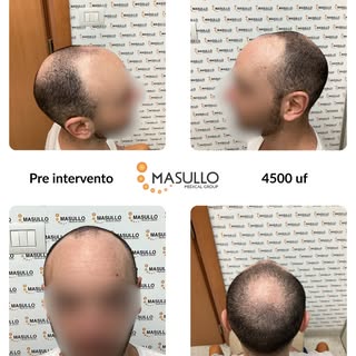 Scorri il carosello per scoprire il percorso e la trasformazione di questo nostro paziente, dopo 11 