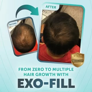 Receding hairline? Thinning crown? We’ve got a solution.

Exo-Fill — RM189
✨ Removes buildup
✨ Calms