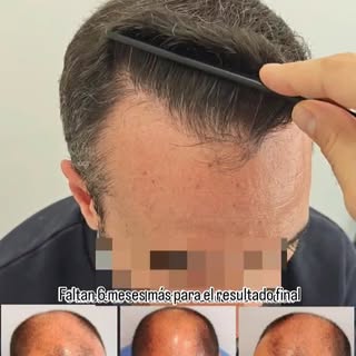 Impresionante el cambio de nuestro paciente! 😱
Se realizó dos intervenciones, la primera ☝🏻para in