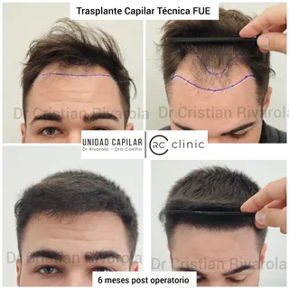 🔥 ANTES / DESPUÉS | 6 MESES | HAMILTON 3

👀 Solo 6 meses... y el cambio ya es espectacular.

Pacie