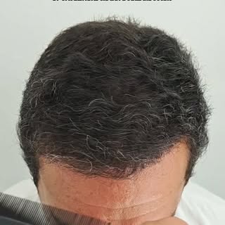 🔥 6 MESES | HAMILTON 4 | UNA SOLA INTERVENCIÓN

👀 Solo 6 meses… y el cambio ya es impresionante.

