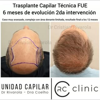 🔥 CASO COMPLEJO | HAMILTON VII | PLANIFICACIÓN EN DOS ETAPAS

No todas las alopecias avanzadas pued