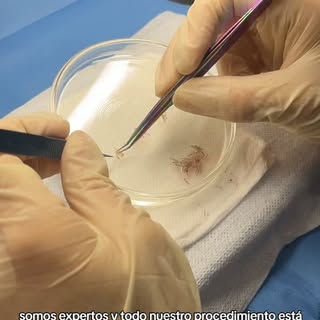 🎯 ¿Sabías que el éxito de un injerto capilar empieza mucho antes de implantar el primer folículo?

