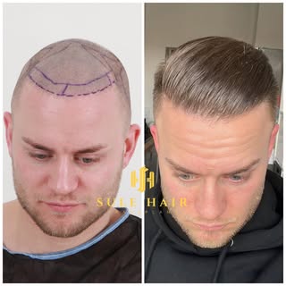 Another incredible result from Sule Hair Clinic. This patient received the maximum number of grafts 