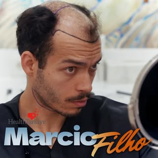 Our patient from Portugal chose Sule Clinic for his hair transplant procedure. ✨

From the initial c