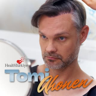 You can watch Mr. Ahonen’s complete hair transplant journey at Sule Clinic, including every stage of