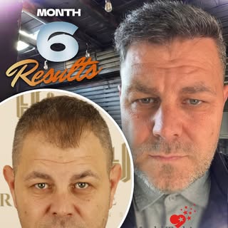 Let’s take a look at the amazing 6-month result of our patient who had a hair transplant procedure a