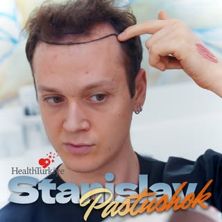 Mr. Pastushok chose Sule Clinic for his hair transplant.

In this video, you can follow every stage 