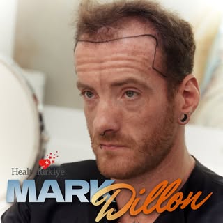 Our patient, Mr. Dillon, traveled from Ireland to Sule Clinic for his hair transplant procedure.

In