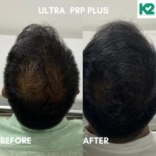 Hairfall , Hairloss treatment with ULTRA PRP- Works wonder #prp #prptherapy #prphairrestoration #prp