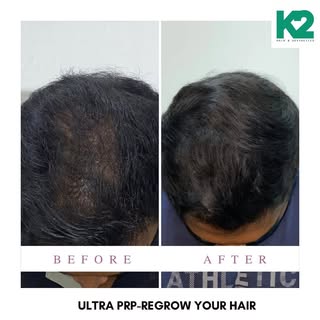 ULTRA PRP- Works wonder #prp #prptherapy #prphairrestoration #prptreatment #hairloss #hair #hairfall
