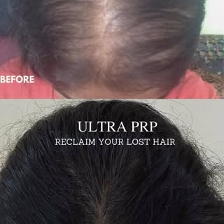ULTRA PRP HAIR THERAPY FOR FEMALE HAIRLOSS AND HAIRFALL