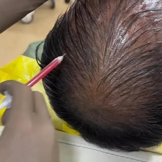 ULTRA PRP PLUS HAIR TREATMENT #prp #prptreatment #prphair #prphairrestoration #prptreatment #prpinje