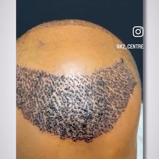 It’s not just a hair transplant, it’s a decision. Choose the right hands!
.
.
.
#k2aestheticandwelln