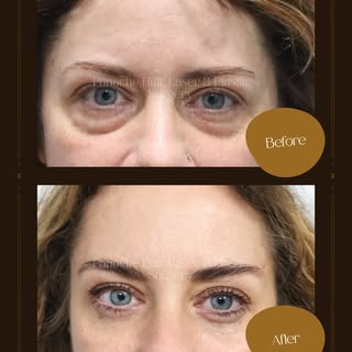Eyes that look as rested as you feel. ✨

This is blepharoplasty — eyelid surgery that removes the ho