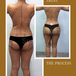 Waist snatched. Curves sculpted. All her own fat.

Brazilian Butt Lift by Dr. Ankit Gupta — 360° lip