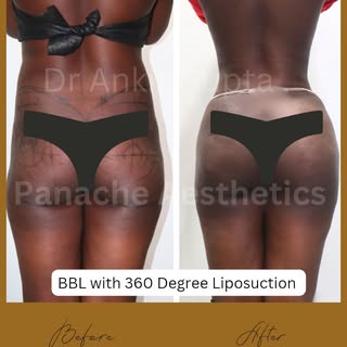 How a Brazilian Butt Lift actually works — and real results from our clinic.

Full caption:
A BBL is