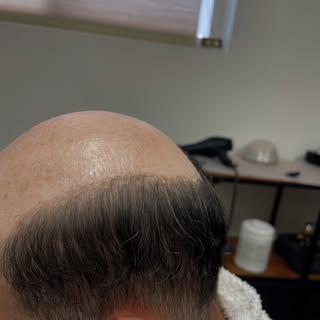 Before & After 💇🏻‍♂️

DM to schedule a consultation 📲

#skinsystem #lacesystem #hairsystem #hairr