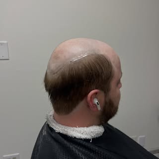 Hair loss solutions are not one-size fits all but our stylists are experts in navigating these compl