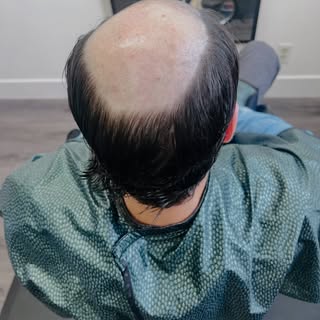 Hair replacement so natural, no one knows 🤫 swipe to see transformation ➡️ 

#hairreplacementspecia