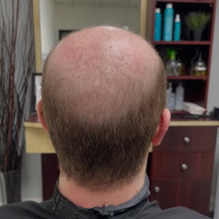 From before to after —a custom transformation designed to look natural, feel comfortable, and bring 