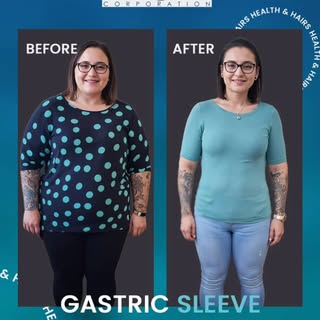This isn’t just weight loss. It’s a new beginning." ✨
 Sleeve Gastrectomy at Health and Hair Clinic
