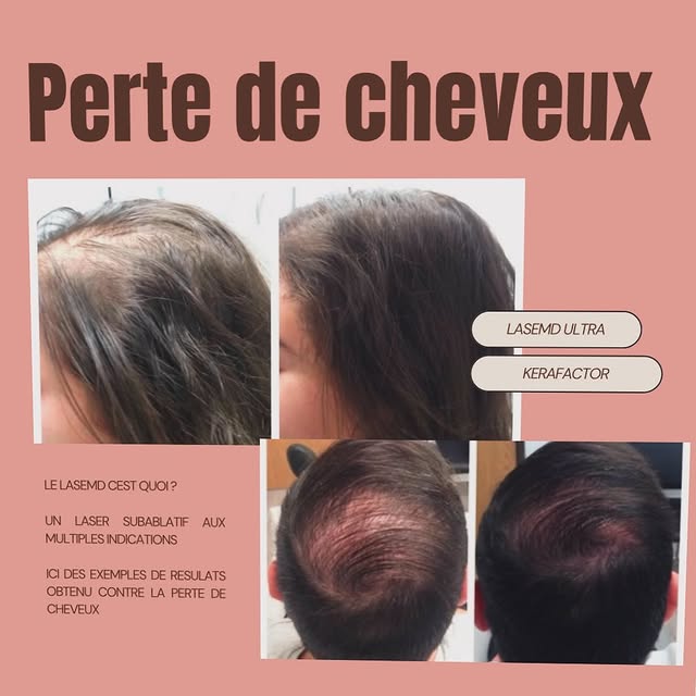❓Keralase est un traitement de grande qualité contre la perte de cheveux qui associe une technologie