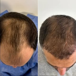Resultados reales, en proceso 👀👇

Implante capilar con técnica FUE ✨
En este caso vemos el antes y