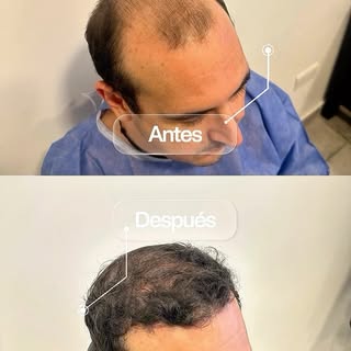 💪🏻🤳🏻Un año de evolución, un cambio que transforma🧑🏻‍🦱✨

En este reel te mostramos un caso rea