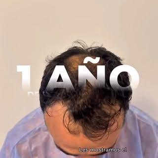 ✨ 1 año de evolución, 1 gran cambio.

En este caso podemos observar el resultado final de un implant