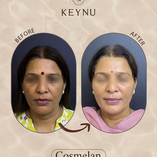 Before → uneven skin tone, stubborn pigmentation, and dull-looking skin.

After → a brighter complex
