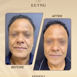 Before → visible skin laxity, softened facial contours, and early signs of ageing.

After → a firmer
