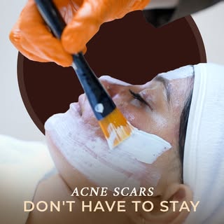 Acne scars tell a story but they don't have to define your skin forever.

With the right diagnosis, 