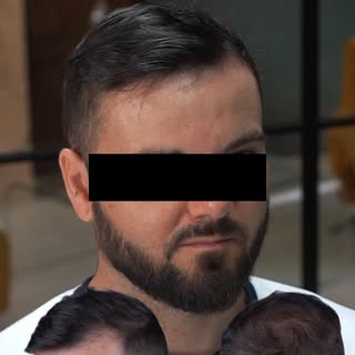 Travail de tricopigmentation effet densité réalisé sur ce jeune homme afin de recréer une chevelure 