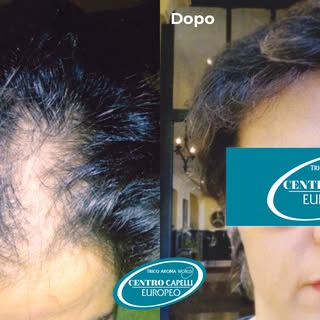 L’#Alopecia femminile esiste, ed è molto più comune di quanto non si pensi: più di 4 milioni di donn