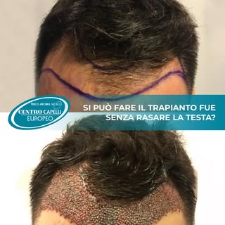 Sì, è possibile eseguire un trapianto di capelli FUE senza rasare tutta la testa.
Tuttavia, non semp