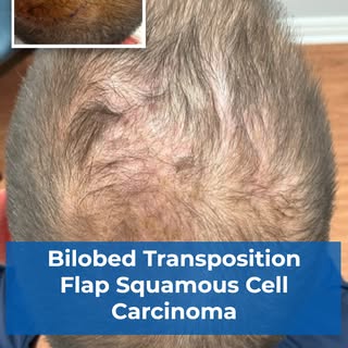 Intense Pulse LIght laser (IPL) can be used to help treat hemangiomas by targeting the blood vessels