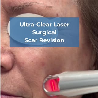 In this video, Dr. Luciana Takata uses the UltraClear laser for scar revision. This advanced treatme