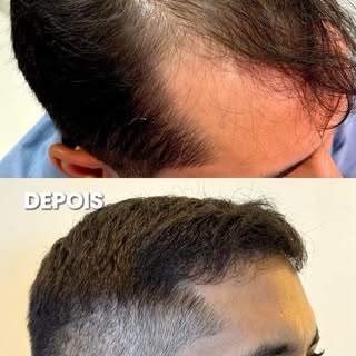 Apresentamos o resultado do paciente Cássio, com 7 meses de evolução após o transplante capilar real