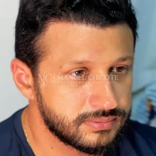 Se liga nessa transformação !!!🔥
Entradas corrigidas , redução de testa com naturalidade ✅
Transpla