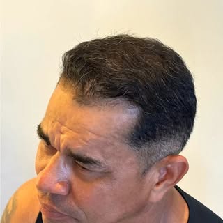 A calvície pode impactar a forma como o homem se vê, se posiciona e se sente diante da própria image