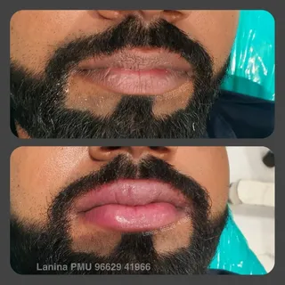 Male lip color correction treatment for dark black patch on lips, browm lip line, lip discoloration 