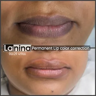 Lip color correction treatment is not only for trand, its for needs, lip problems like dark black pa