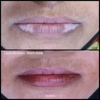 White Patch cover-up treatment on lips, patches on lip is very common problems for man and woman res