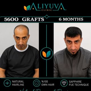 🔥 5600 Grafts | Incredible 6-Month Transformation 🇸🇦

At Ali Yuva Clinic, our patient achieved a 