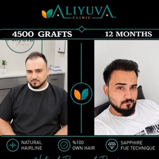 🇮🇶 4500 Grafts | 12-Month Result | Incredible Transformation at Ali Yuva Clinic

Our patient from 