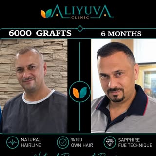 ✨ 6000 Grafts | Amazing 6-Month Hair Transformation!

Hair transplantation is about more than restor