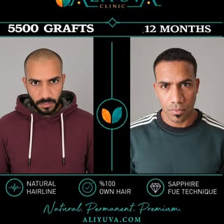 🔥 5500 Grafts | 12 Months | Natural & Impressive Result

A successful hair transplant is not only a