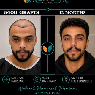 🔥 5400 Grafts | 12 Months | A Noticeable Difference 🇰🇼

Sometimes the biggest changes are the one